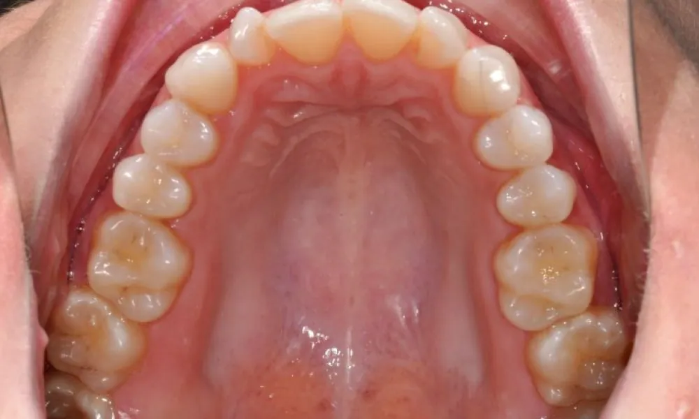 Clinical photo from Becca's surgically accelerated orthodontics case